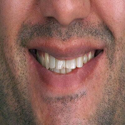 قبل-از-انجام-کامپوزیت-دندان