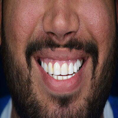 قبل-از-کامپوزیت-دندان-در-کلینیک-آفرینش