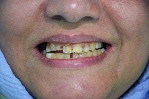 قبل از کامپوزیت دندان در کلینیک آفرینش