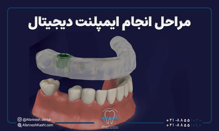 مراحل انجام ایمپلنت دیجیتال دندان