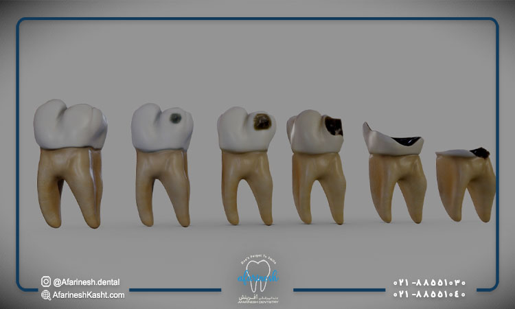 روش توقف پوسیدگی دندان