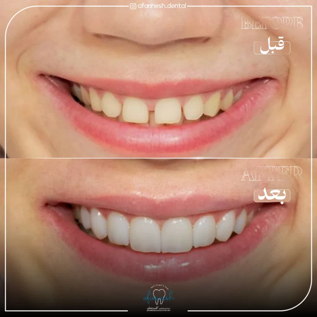 قبل و بعد کامپوزیت دندان