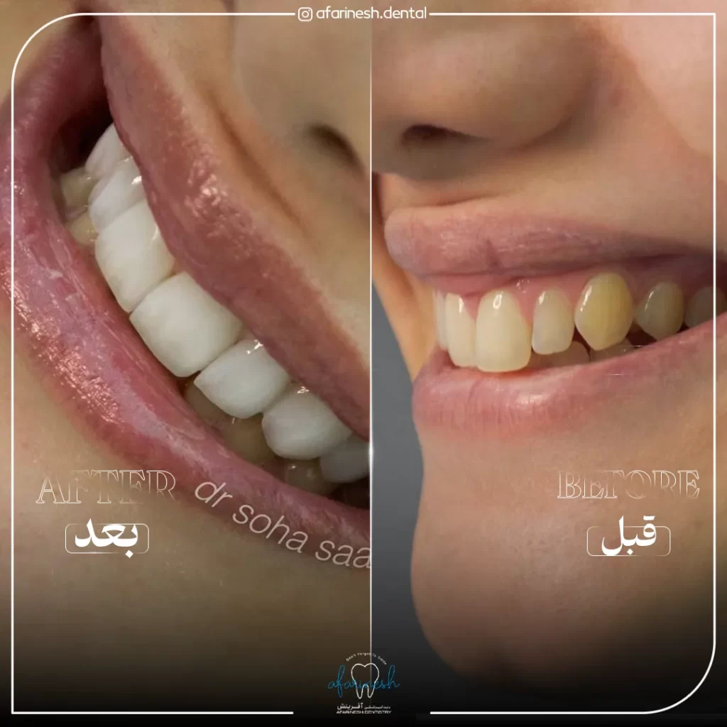 تصویر قبل و بعد کامپوزیت دندان