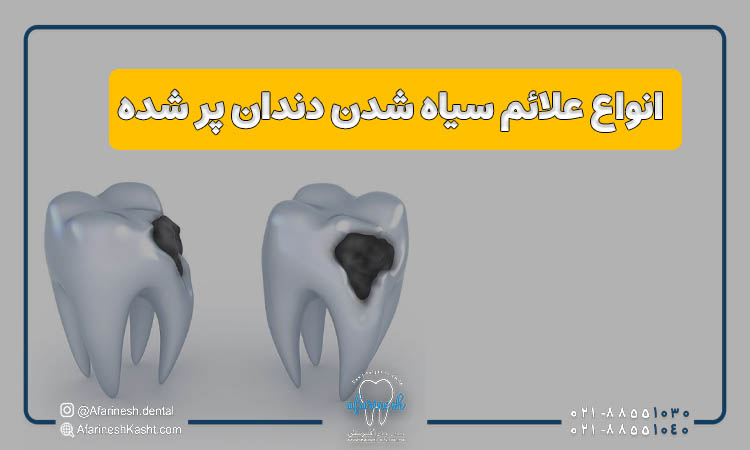 انواع علائم سیاه شدن دندان پر شده