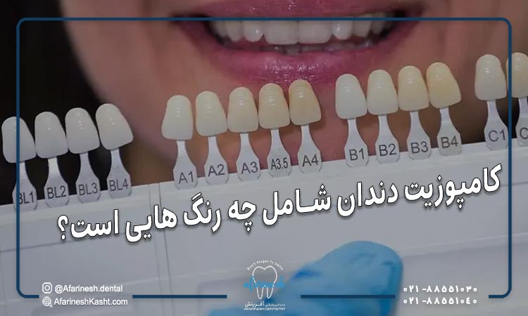 کامپوزیت دندان شامل چه رنگ هایی است؟