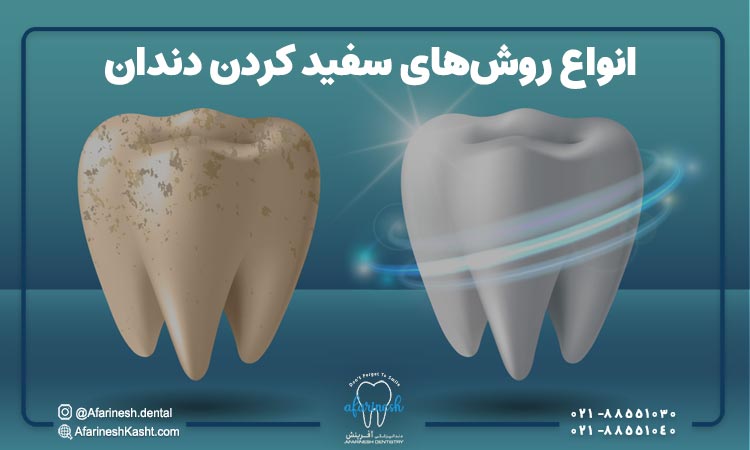 انواع روش‌های سفید کردن دندان